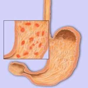 Prvi znaki in simptomi gastritis želodcu