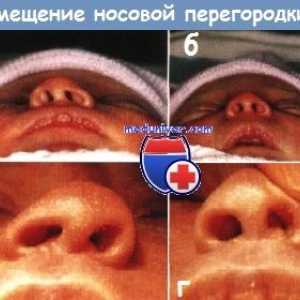 Indikacije in kontraindikacije za zdravljenje nosnega septuma premikom pri novorojenčkih