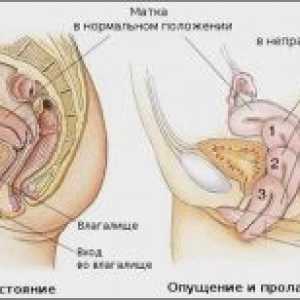 Malformacije maternice: diagnosticiranje in zdravljenje