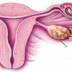 Izguba nosečnosti: cervical insuficienca
