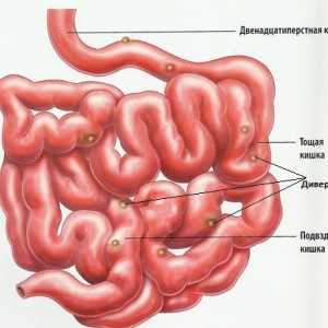 Vzroki za črevesja diverticulosis v otroka in odraslega