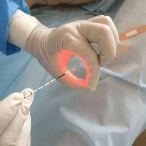 Laser Kauterizacija želodcu kot metoda zdravljenja