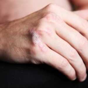 Psoriatično artropatijo, zdravljenje, simptomi, znaki, vzroki