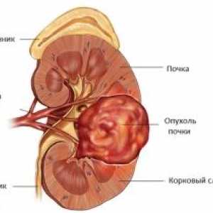 Karcinom ledvičnih medenice in sečevod: znaki, simptomi, vzroki, zdravljenje