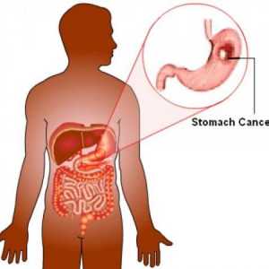 Rak na želodcu: patogeneza, histologijo, kako dolgo
