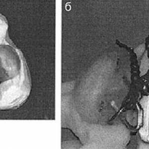 Zgodnje ortopedsko zdravljenje bolnikov z obojestransko heiloshize in neba z uporabo fiksnih naprav…