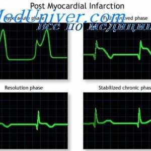 Okrevanje zaradi miokardnega infarkta. Počitek po srčnem napadu