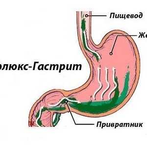 Povratni gastritis: Znaki, simptomi in zdravljenje