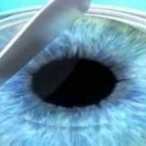 Kirurgija refrakcije oči: Kaj je to?