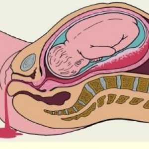 Rektalna krvavitev med nosečnostjo
