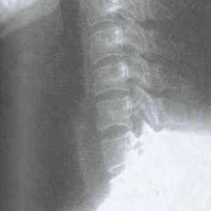 Rentgenografski študija materničnega vratu osteohondroze