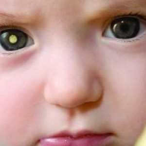 Retinoblastom pri otrocih: simptomi, zdravljenje, vzroki, simptomi