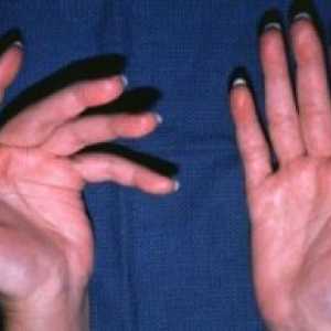 Revmatoidni artritis zapestja: simptomi, zdravljenje, vzroki, simptomi