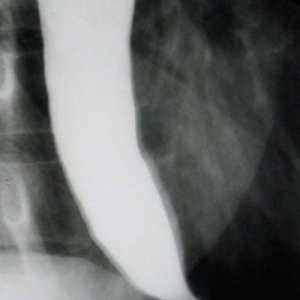 Rezultati rentgenskim pregledom požiralnika in želodca