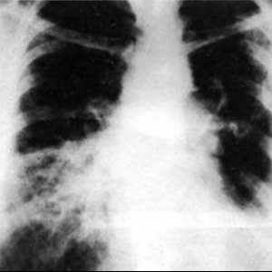 Rezultati torakoskopske pljuč biopsijo