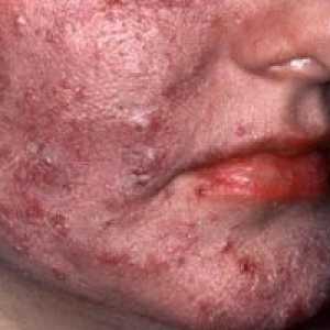 Koža rozacee: zdravljenje, simptomi, vzroki, simptomi