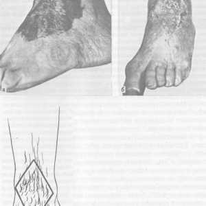 Brazgotina deformacija stopala in gležnja