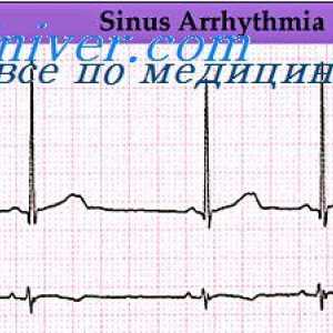 Srčne aritmije. Kršitev ritmu sinusnega vozla