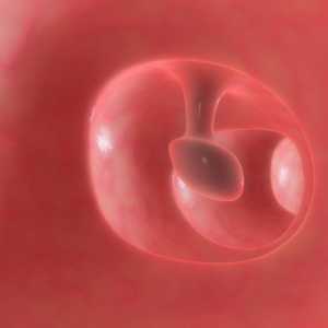 Simptomi in zdravljenje polypoid gastritis