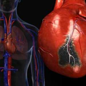 Sindrom nenadne srčne smrti
