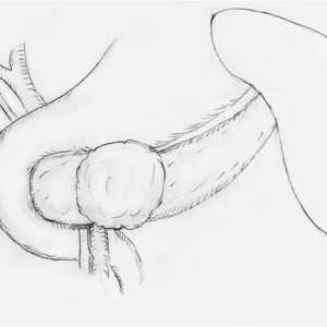 Pseudopapillary-solidni tumor trebušne slinavke