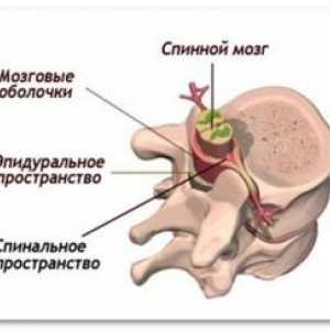 Spinal epiduralna absces: zdravljenje, vzroki, preprečevanje