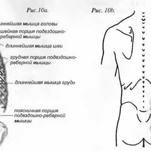 Bolečine v hrbtu, ki jih mišice erector spinae povzroča
