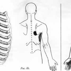 Bolečine v hrbtu, ki jih je serratus anterior mišice povzroča