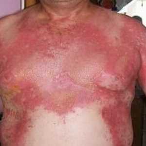 Stafilokokni eksfoliativni dermatitis: zdravljenje, vzroki, simptomi, znaki