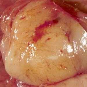 Želodca gastrointestinalni stromalni tumor (GIST zgod)