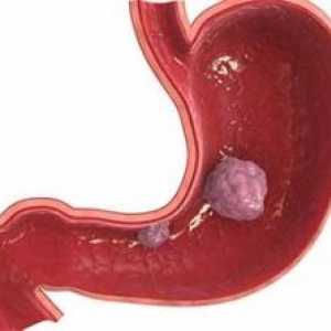 Stromalni tumorji gastrointestinalnega trakta: simptomi, zdravljenje, simptomi