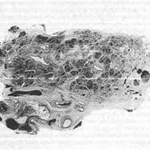 Stromalni komponente trebušna slinavka
