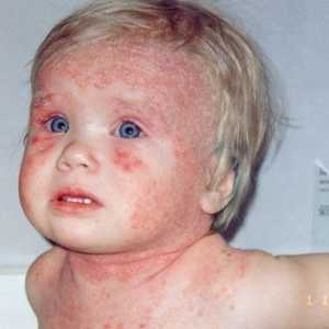 Izpuščaj pri otroku na dysbacteriosis