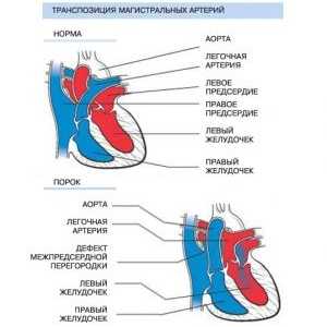 Prenos velikih arterij: povzroča, kirurgije, zdravljenje, simptomi, znaki