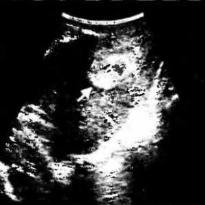 Transvaginalnih ultrazvok diagnoza poporodne endometritisa