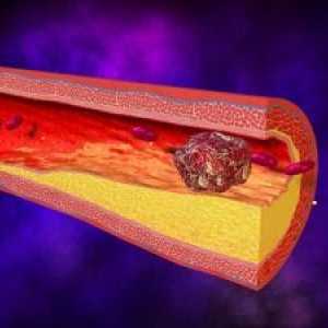 Tromboza arterij zgornjih okončin