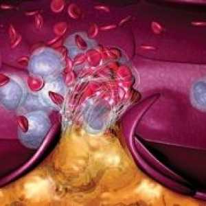 Tromboza in pljučna embolija