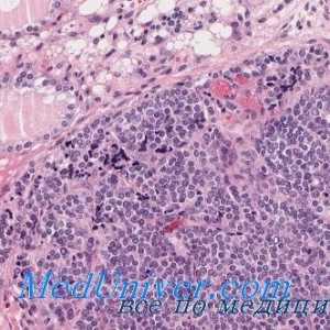 Tuberkuloza morfologije ščitnice, patološka anatomija