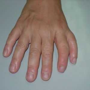 Podvojitev prvi prst (ali pramena preaxial Polydactyly)