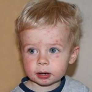 Akne je otrok: Zdravljenje
