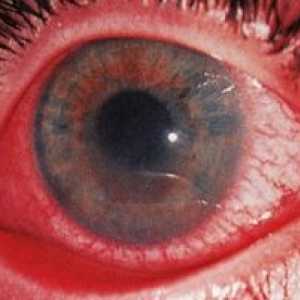 Uveitis oči: zdravljenje, simptomi, vzroki, simptomi, diagnostika