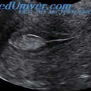 UZI jajcevodih. Transvaginalnih ultrazvok okrogle vezi in črevesje