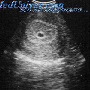 Ultrazvok je v prvem trimesečju nosečnosti. Indikacije za transvaginalno ultrazvoka v prvem…