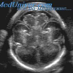 Pred rojstvom oskrba z ventriculomegaly. prirojene hidrocefalus