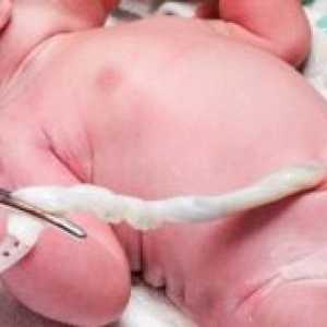 Prolaps popkovnice ob rojstvu: učinki, so vzroki
