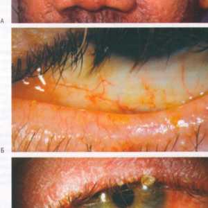 Bolezni veznice očesno rozaceo