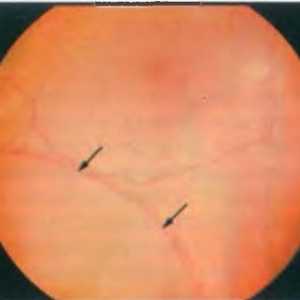Bolezni obodu mrežnice: degenerativne retinoschisis