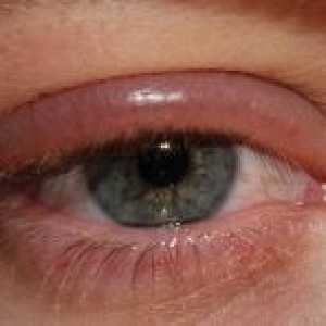 Bolezni stoletja človeškega očesa: zdravljenje, preprečevanje, znaki, simptomi, vzroki