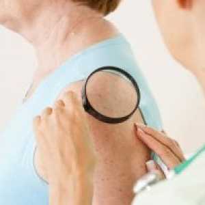 Maligni tumorji kože: klasifikacija